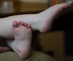 Syndrome pied main bouche pour mon bébé ! La Maladie Pieds Mains Bouche