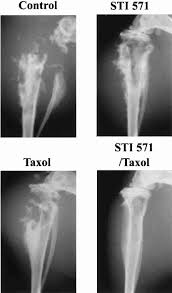 The symptoms of bone cancer will vary, depending on the size of the cancer and where it is in the body. Digital Radiography Of Pc 3mm2 Derived Bone Tumors Growing In Hind Legs Download Scientific Diagram