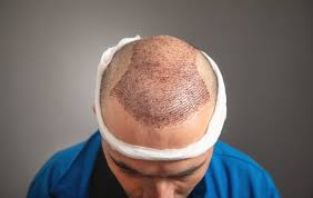 Hair transplant procedure