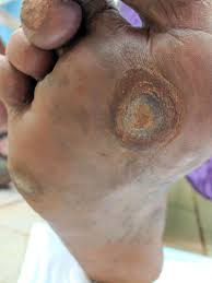 Image result for toe black diabetes