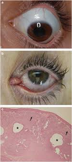 Maybe you would like to learn more about one of these? Lesions Of The Caruncle A Description Of 42 Cases And A Review Of The Literature Eye