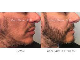 Most commonly, this hair for beard implant comes from the patients back of the head or from under the chin if there's any visible growth there. Facial Transplant Beard Hair Transplant Before And After Photos Los Angeles Hair Restoration