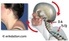 Why did you develop this strange hump on your back? Brenda S Dowager S Hump Erik Dalton Blog