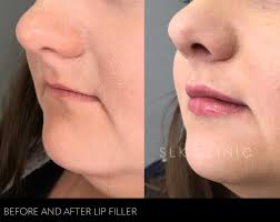 How does juvederm help to augment the chin? Before And After Photos Lip Filler Chin Augmentation Tear Trough And Under Eye Filler