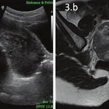 Abdominal, or transabdominal ultrasounds can produce images of the bladder, uterus, cervix, ovaries and fallopian tubes. Pdf Role Of Abdominal Ultrasonography As A Preliminary Imaging Technique In The Assessment Of Female Pelvic Pathologies