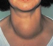 Bimari ka hindi arth, matlab kya hai?. à¤¥ à¤¯à¤° à¤‡à¤¡ à¤• à¤²à¤• à¤·à¤£ à¤• à¤°à¤£ à¤µ à¤‰à¤ªà¤š à¤° Thyroid Symptoms Treatment In Hindi