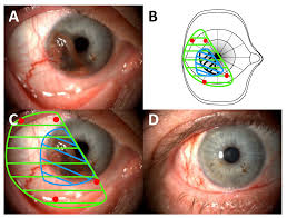 Image result for conjunctival melanoma