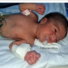 PDF) Isolated distal esophageal atresia in neonates: a case report and  review of the literature