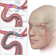 Feasibility of super-bore 0.088″ mechanical thrombectomy in M1 vessels  smaller than 8 French: Experience in 20 consecutive cases