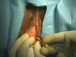 A bartholin cyst is commonly painless, however some people may experience some tenderness in the area. Bartholin S Gland Cyst Word Catheter Full Details Procedures Consult Youtube