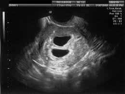 Image result for First Trimester Ultrasound