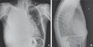 Is a novel mesothelial positive marker for malignant mesothelioma (figure 3c). Malignant Pleural Mesothelioma With Trapped Lung Thoracic Key