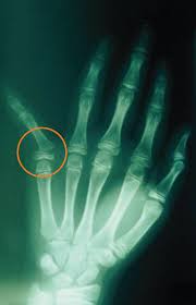 Image result for Hand Growth Plates