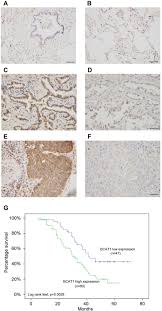 Should weak cancer patients eat meat, fish, etc.? Bcat1 Overexpression Promotes Proliferation Invasion And Wnt Signaling In Non Small Cell Lung Cancers