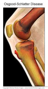 A Color X Ray Of Osgood Schlatter Knee Disease A Novel Advanced Visual Tool To See And Understand Anatomy Disease And Surgery Created By Medical Medi Medisch