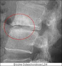 Erosive Osteochondrose
