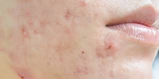 Heavy or irregular periods, including missed periods, a stopped period, or a frequent period hirsutism, or excessive hair on the face,. Hormonal Acne 5 Signs You Re Dealing With It And How To Treat It Self