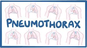 Image result for Open Pneumothorax