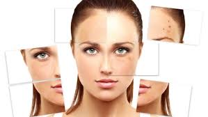 Image result for Melasma