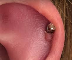 Piercing Bump: 6 Ways To Get Rid Of Cartilage Or Nose Keloid, Blister