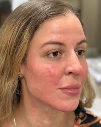 Bella, eu só tiro foto do lado que minha mandíbula é marcada, odeio essa  assimetria!” Revolvido! ✓ E trabalhamos em toda face trazendo lifting,  descanso, novas projeções e uma autoconfiança enorme! 10ml