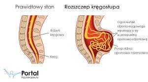 Rdzeń kręgowy to substancja szara zawierająca komórki nerwowe wraz z innymi różnymi pomocniczymi komórkami umożliwiającymi. Rozszczep Kregoslupa Portal Fizjoterapeuty