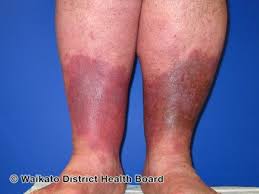 Image result for Lipodermatosclerosis