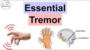 Image result for Tremor