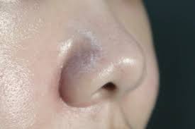 Beberapa cara ampuh ini bisa kamu coba. Hitam Di Hidung Bukanlah Komedo Tapi Sebaceous Filaments