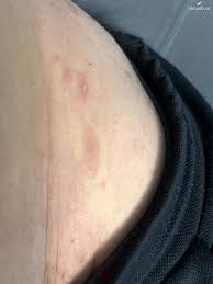 Genital ve Krem Şikayetleri - Şikayetvar