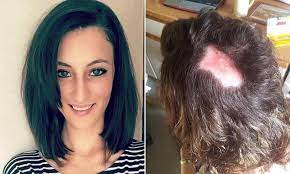 Woman Left With A Permanent Bald Patch After Getting Highlights Bald Patches Women Bald Patches Balding