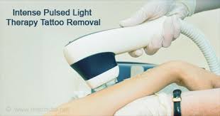 Afterward, rinse the tattoo with warm water. Tattoo Removal Methods