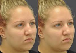 Mark Been, MD, Board Certified Facial Plastic Surgeon