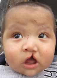 As your child recovers, they will require less and less pain medicine. Cleft Lip And Cleft Palate Wikipedia