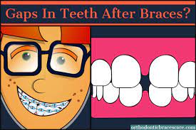 Teeth bonding | fixing gap teeth without braces. Gaps In Teeth After Braces Is It Normal How To Fix It Orthodontic Braces Care