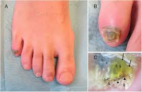 Image result for Onychotillomania feet