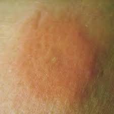 Atopic dermatitis is an ongoing (chronic) condition that makes skin red and itchy. Skin Rash Causes 68 Pictures Of Symptoms And Treatments