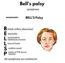 Image result for Progressive Bulbar Paralysis