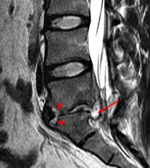 The trunk line has multiple fiber optic cables combined together to increase the capacity. Discitis Radsource