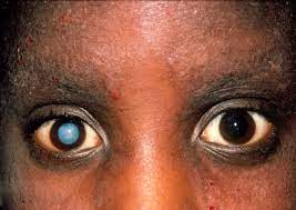 Cataracts are the leading cause of blindness in adults worldwide. Cataract Eye Disorders Msd Manual Consumer Version