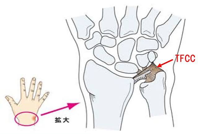 TFCC損傷とは？症状・原因・治療法を解説 | やまべ整形外科