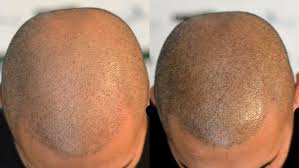 La tricopigmentazione (micropigmentazione del cuoio capelluto/smp) è un trattamento . La Tricopigmentazione Contro La Calvizie Non Solo Tatuaggi