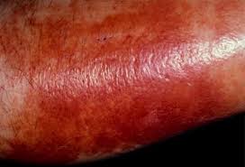 Image result for Skin Infection