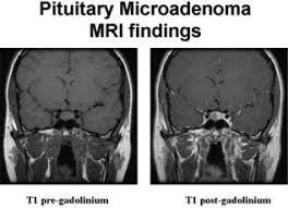 Pituitary Tumors Result From A Single Cell Losing The Ability To Control Its Growth These Tumors Are Almost Always Benign Or Non Ca Brain Tumor Tumor Cushings