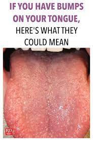 If You Have Bumps On Your Tongue Here S What They Could Mean Tongue Health Bumps On Tongue Tongue Sores