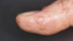 Dyshidrose Altmeyers Enzyklopadie Fachbereich Dermatologie