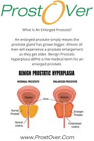 Enlarged Prostate Benign Prostatic Hyperplasia In 2020 Benign Prostatic Hyperplasia Enlarged Prostate Prostate