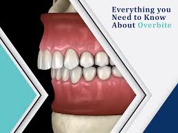 Check spelling or type a new query. Everything You Need To Know About Dental Overbite Condition