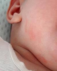Ausschlag Hals Forum Baby Urbia De