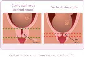 Tratamiento Con Progesterona Para Prevenir El Nacimiento Prematuro Nacersano